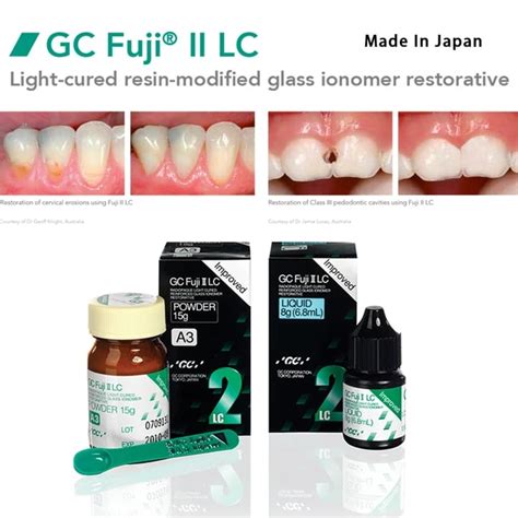 Fuji Light Cured Glass Ionomer Online Offers Pinnaxis