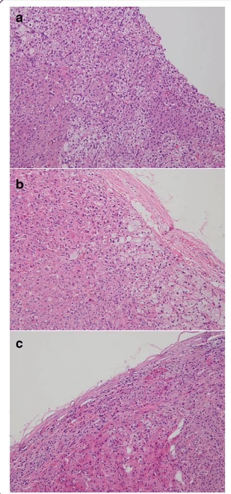 Pathological Findings Of The Resected Adrenal Glands Pathological