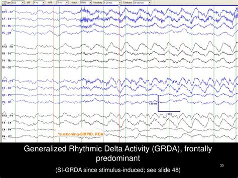 Ppt American Clinical Neurophysiology Society’s Standardized Critical Care Eeg Terminology