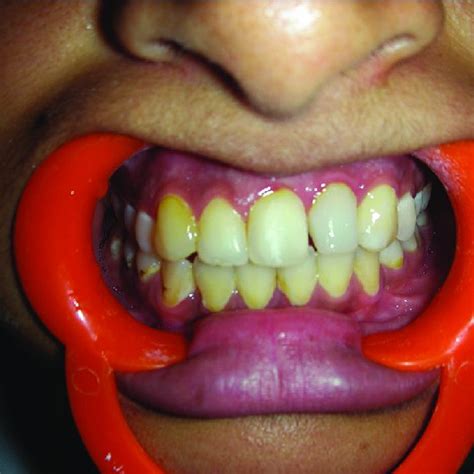 Porcelain Veneer For The Maxillary Left Central Incisor Download
