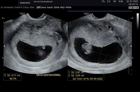 Ultrassonografia Obst Trica Transvaginal Hector Andres