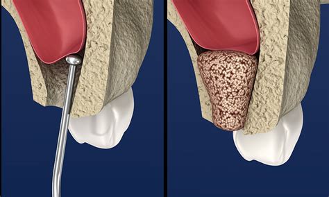 Dental Bone Graft Cost Materials And Procedure Omega Dental