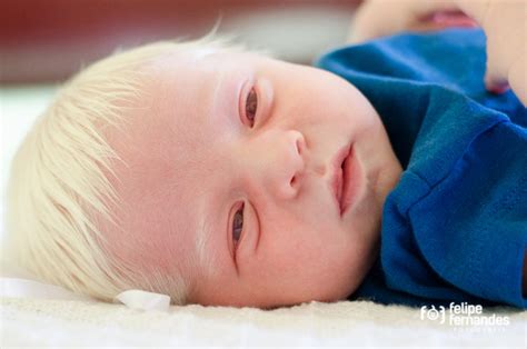 Albinism (Achromasia) — Definition and Genetics | Lecturio