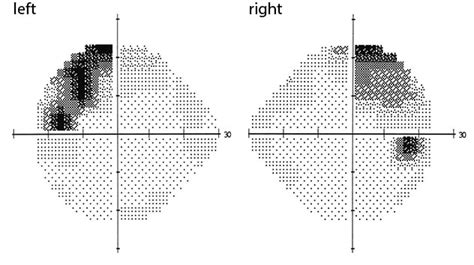 Pituitary Tumor In A Patient With Hydrocephalus: A, 52% OFF