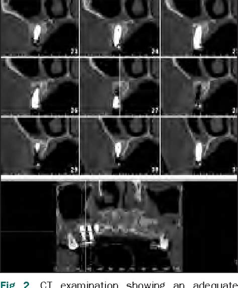 Figure 2 From Maxillary Sinus Grafting With Biphasic Calcium Phosphate