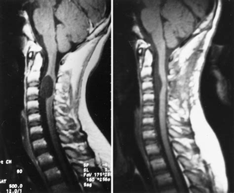 Spinal Intradural Arachnoid Cysts Located Anterior To The Cervical