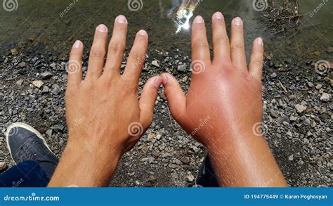 Swollen Hand Allergy To Bee Stings Two Hands Of A Person Stock Image