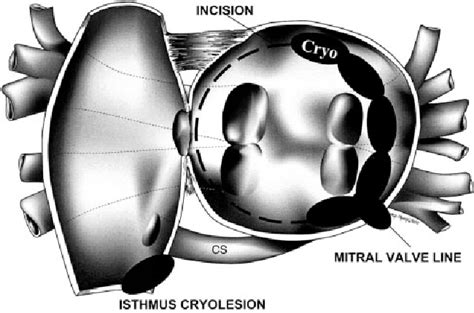 Figure 1 From Role Of The Posterior Left Atrium And Pulmonary Veins In Human Lone Atrial