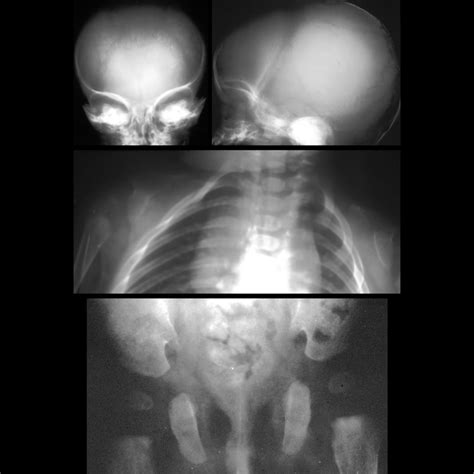 Cleidocranial Dysostosis Radiology