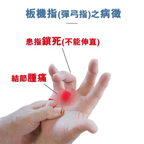 Medex H15b Trigger Finger Splint With Cinch Device 夜用板機指矯形護托附微調拉繩器