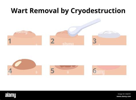 cryodestruction procedure showing  steps  wart removal process
