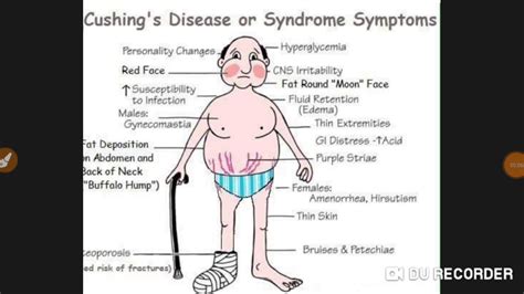 Cushing Syndrome And Disease Lecture Youtube