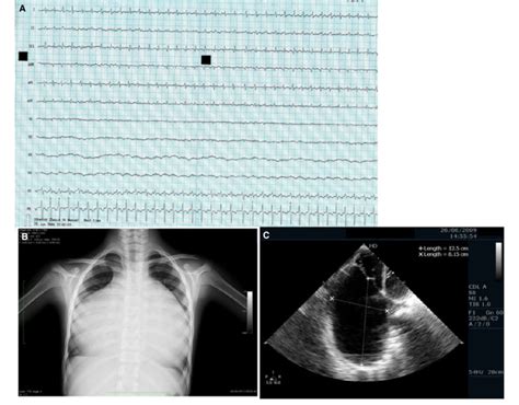 A Electrocardiogram ECG Shows Atrial Tachycardia With 2 1 AV Block