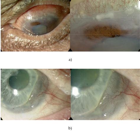 Adenovirus Keratitis