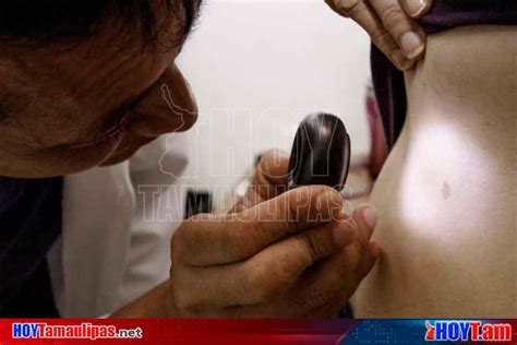 Hoy Tamaulipas Experta Afirma Que El Melanoma Es El Cancer De Piel