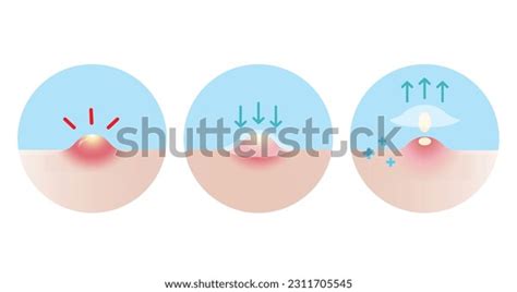 Direction Use Acne Pimple Patch Inflammatory Stock Vector Royalty Free