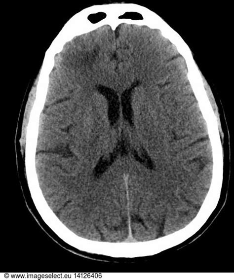 Brain Contusion Brain Contusion, CT scan,abnormal,abnormality,acute - Rights Managed ...