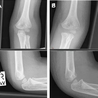 Representative X-ray of a fracture of the lateral condyle not matching ...