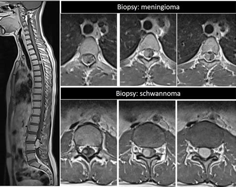 Two Spinal Lesions Schwannoma And Meningioma Radiology Cases