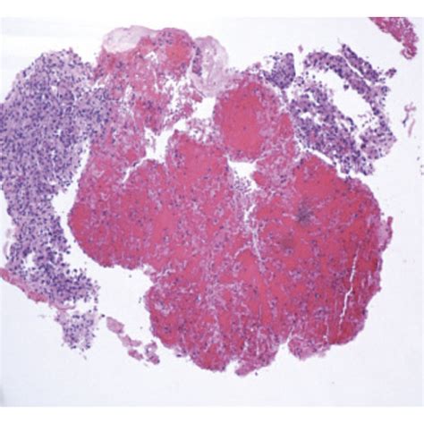 A Cell Block 4x Hande Of The Thyroid Showing Atypical Cells Which Download Scientific