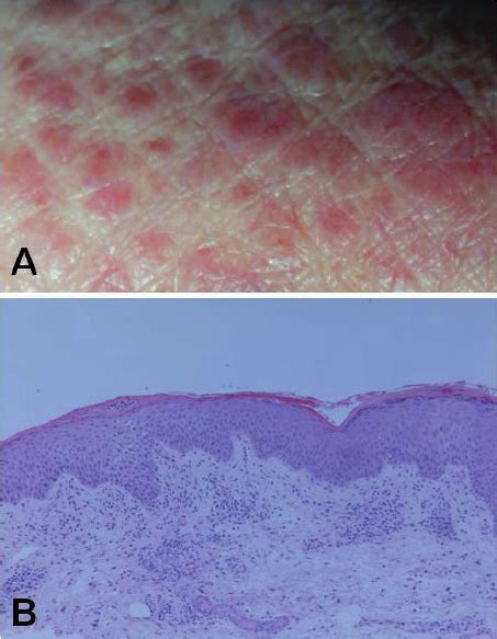 Clinical And Histological Manifestations Of Lichenoid Papules A Download Scientific Diagram