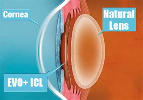 Visian Icl Vision Correction For Visual Freedom Dr Ahmed El Moatassem