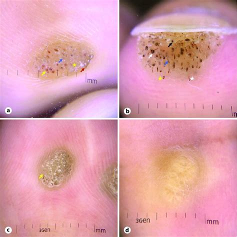 Dermoscopic Features Of Wart Lesions At ×10 Magnification A A Plantar