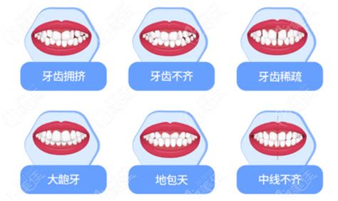 阆中牙齿矫正价格表含阆中成人隐形钢牙套正畸和儿童牙齿矫正费用最热整形行业新闻话题 美佳网