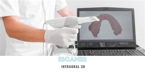 Para Qu Sirve El Escaner Intraoral D Cl Nica I Bl Dental