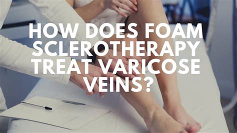 Sclerotherapy How Does Foam Sclerotherapy Treat Varicose Veins Youtube