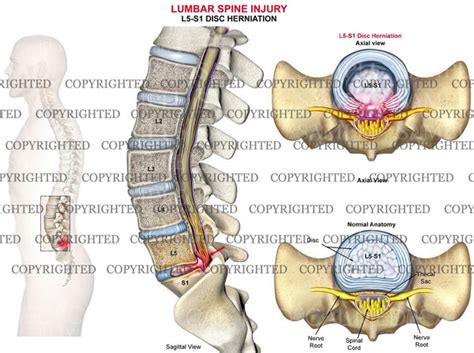 Lumbar spine disc herniation L5-S1 - male — Medical Art Works