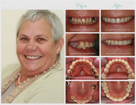 Teeth Implant Cost In South Africa Silver Oaks Dental Clinic