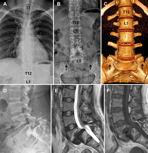 Transitional Anatomy Lumbar Spine Radiology Human Anatomy