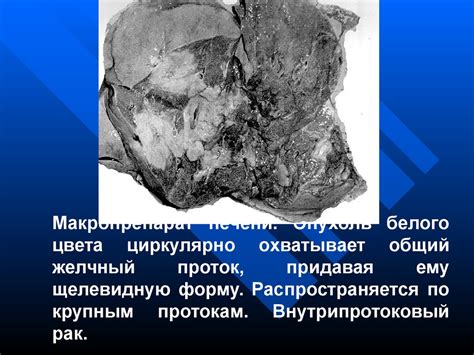 Рак печени - презентация онлайн