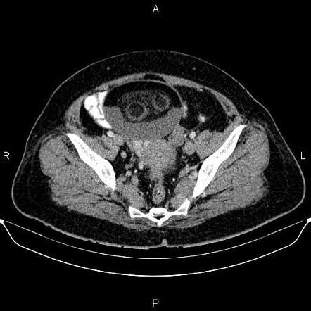 Mature Cystic Ovarian Teratoma Radiology Case Radiopaedia Org