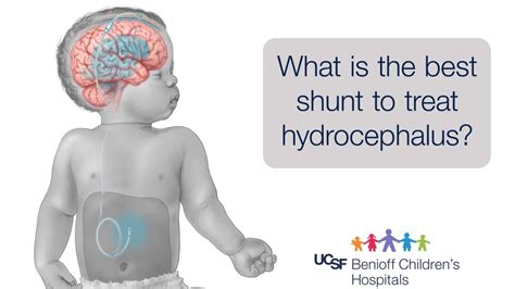 Hydrocephalus The Workhorse Shunt Ucsf Pediatrics