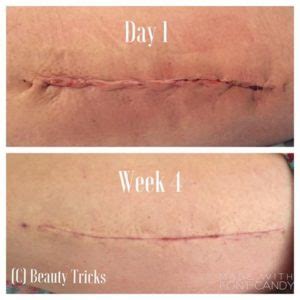 Miraculous recovery of my scar (Thanks to Luminesce Cellular ...