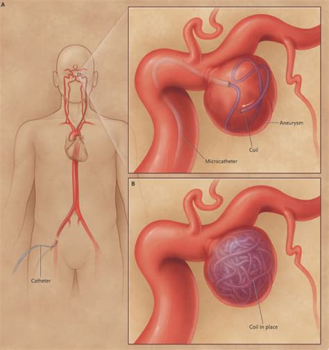 Cerebral Aneurysm Coiling