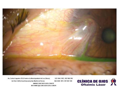 Clínica de Ojos Oftalmic Láser PTERIGION Optometría