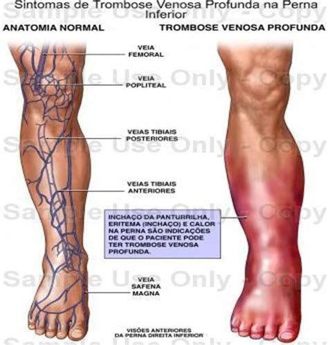 Trombosis Venosa Profunda