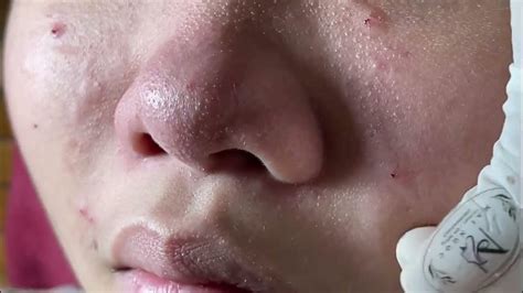 Acne Nose Acne Treatment Mai Ngọc Youtube