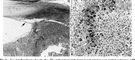 Figure 2 From Ocular Histopathology Of Vogt Koyanagi Harada Like