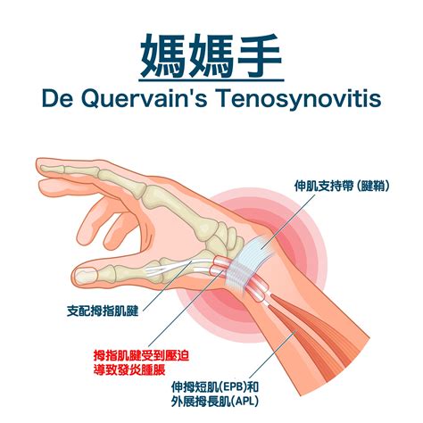 媽媽手 De Quervain s Tenosynovitis 媽媽手的症狀及治療 手腕疾病專欄 手外科醫師