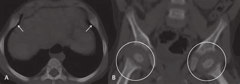 Axial Ct Cuts In Bone Window Through The Lower Thorax Bilateral