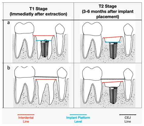 Medicina Free Full Text Interdental Bone Level Around Immediately