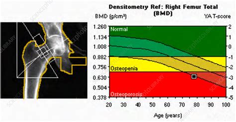 Osteoporosis, X-ray bone densitometry - Stock Image - C039/3259 - Science Photo Library