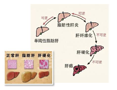 脂肪肝，不是肝脏长胖那么简单 腾讯新闻