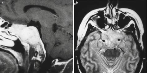 plasmacytoma neupsy key