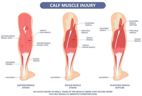 Calf Strain Management In Singapore Straits Podiatry