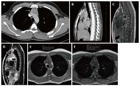 Imaging Of The Pediatric Thymus Clinicoradiologic Approach